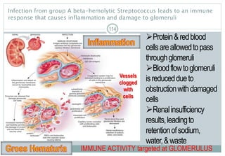 114
Infection from group A beta-hemolytic Streptococcus leads to an immune
response that causes inflammation and damage to glomeruli
114
Protein&redblood
cellsareallowedtopass
throughglomeruli
Bloodflowtoglomeruli
isreduceddueto
obstructionwithdamaged
cells
Renalinsufficiency
results,leadingto
retentionofsodium,
water,&waste
IMMUNE ACTIVITY targeted at GLOMERULUS
Vessels
clogged
with
cells
 
