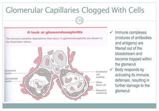 Glomerular Capillaries Clogged With Cells
115
 Immune complexes
(mixtures of antibodies
and antigens) are
filtered out of the
bloodstream and
become trapped within
the glomeruli
 Body responds by
activating its immune
defenses, resulting in
further damage to the
glomeruli
 