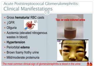 116
Acute Poststreptococcal Glomerulonephritis:
Clinical Manifestations
 Gross hematuria/ RBC casts
 ↓GFR
 Oliguria
 Azotemia (elevated nitrogenous
wastes in blood)
 Hypertension
 Periorbital edema
 Brown foamy frothy urine
 Mild/moderate proteinuria
116116
Tea- or cola-colored urine
The most common clinical sign of glomerulonephritis is blood in the urine
 