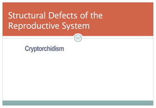 167
Cryptorchidism
Structural Defects of the
Reproductive System
167167
 