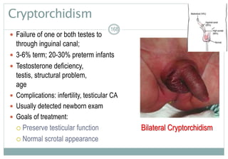 168
Cryptorchidism
 Failure of one or both testes to descend
through inguinal canal; hidden testis
 3-6% term; 20-30% preterm infants
 Testosterone deficiency, an defective
testis, structural problem, early gestational
age
 Complications: infertility, testicular CA
 Usually detected newborn exam
 Goals of treatment:
 Preserve testicular function
 Normal scrotal appearance
168
Bilateral Cryptorchidism
 