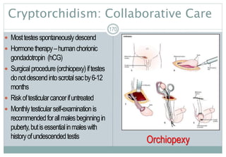 Cryptorchidism: Collaborative Care
 Mosttestesspontaneouslydescend
 Hormonetherapy–humanchorionic
gondadotropin (hCG)
 Surgicalprocedure(orchiopexy)iftestes
donotdescendintoscrotalsacby6-12
months
 Riskoftesticularcancerifuntreated
 Monthlytesticularself-examinationis
recommendedforallmalesbeginningin
puberty,butisessentialinmaleswith
historyofundescendedtestis
170
Orchiopexy
 