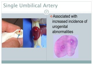 27
Single Umbilical Artery
Associated with
increased incidence of
urogenital
abnormalities
27
 