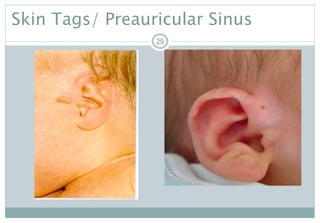 29
Skin Tags/ Preauricular Sinus
29
 