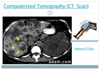 41
Computerized Tomography (CT Scan)
4141
Abdomen CT Scan
 
