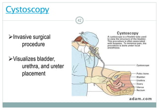 42
Cystoscopy
42
Invasive surgical
procedure
Visualizes bladder,
urethra, and ureter
placement
42
 