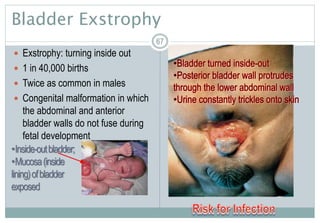67
Bladder Exstrophy
 Exstrophy: turning inside out
 1 in 40,000 births
 Twice as common in males
 Congenital malformation in which
the abdominal and anterior
bladder walls do not fuse during
fetal development
6767
•Inside-outbladder;
•Mucosa(inside
lining)ofbladder
exposed
 