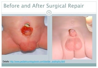70
Before and After Surgical Repair
70
Details: http://www.pediatricurologybook.com/bladder_exstrophy.html
 