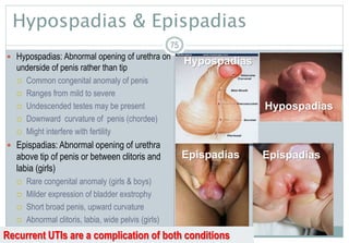 75
Hypospadias & Epispadias
75
Hypospadias
EpispadiasEpispadias
Hypospadias
Recurrent UTIs are a complication of both conditions
 Hypospadias: Abnormal opening of urethra on
underside of penis rather than tip
 Common congenital anomaly of penis
 Ranges from mild to severe
 Undescended testes may be present
 Downward curvature of penis (chordee)
 Might interfere with fertility
 Epispadias: Abnormal opening of urethra
above tip of penis or between clitoris and
labia (girls)
 Rare congenital anomaly (girls & boys)
 Milder expression of bladder exstrophy
 Short broad penis, upward curvature
 Abnormal clitoris, labia, wide pelvis (girls)
 