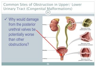 84
Common Sites of Obstruction in Upper/ Lower
Urinary Tract (Congenital Malformations)
84
84
 Why would damage
from the posterior
urethral valves be
potentially worse
than other
obstructions?
 