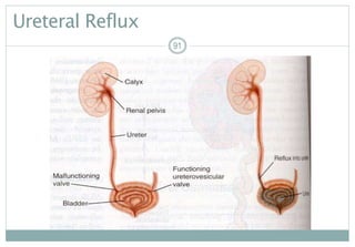 91
Ureteral Reflux
9191
 