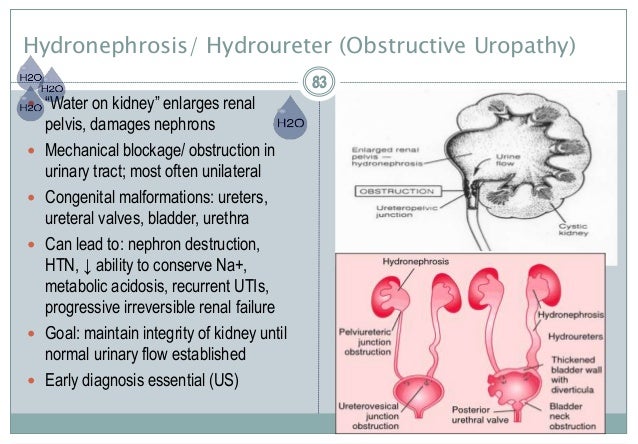 Acute unilateral obstructive uropathy