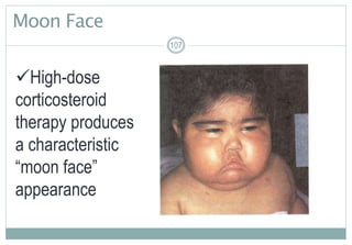 107
Moon Face
107
High-dose
corticosteroid
therapy produces
a characteristic
“moon face”
appearance
107
 
