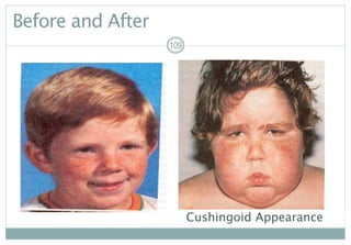 109
Before and After
109109
Cushingoid Appearance
 