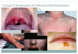Group A Streptococcal Infection Manifestations
113
 