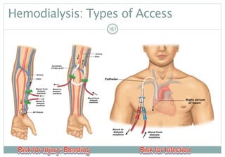 161
Hemodialysis: Types of Access
161161
 