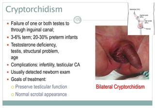 170
Cryptorchidism
 Failure of one or both testes to descend
through inguinal canal; hidden testis
 3-6% term; 20-30% preterm infants
 Testosterone deficiency, an defective
testis, structural problem, early gestational
age
 Complications: infertility, testicular CA
 Usually detected newborn exam
 Goals of treatment:
 Preserve testicular function
 Normal scrotal appearance
170
Bilateral Cryptorchidism
 