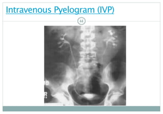 44
Intravenous Pyelogram (IVP)
4444
 