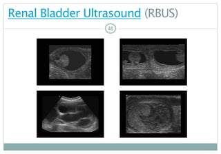 48
Renal Bladder Ultrasound (RBUS)
4848
 