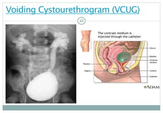 49
Voiding Cystourethrogram (VCUG)
4949
 