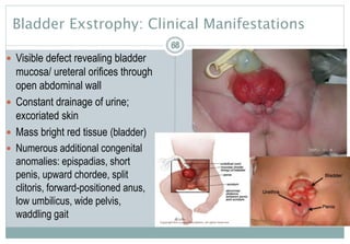 68
Bladder Exstrophy: Clinical Manifestations
 Visible defect revealing bladder
mucosa/ ureteral orifices through
open abdominal wall
 Constant drainage of urine;
excoriated skin
 Mass bright red tissue (bladder)
 Numerous additional congenital
anomalies: epispadias, short
penis, upward chordee, split
clitoris, forward-positioned anus,
low umbilicus, wide pelvis,
waddling gait
6868
 