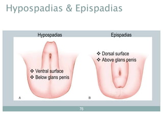 7676
76
Hypospadias
 Ventral surface
 Below glans penis
Epispadias
 Dorsal surface
 Above glans penis
Hypospadias & Epispadias
 