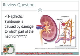 Review Question
96
Nephrotic
syndrome is
caused by damage
to which part of the
nephron?????
MinimalChangeNephroticSyndrome/ Effacement of foot processes
 