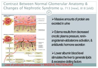 97
Contrast Between Normal Glomerular Anatomy &
Changes of Nephrotic Syndrome (p. 713 [new], 818 [old])
97
Massiveamountsofproteinare
excretedinurine
Edemaresultsfromdecreased
oncoticplasmapressure,renin-
angiotensin-aldosteroneactivation,&
antidiuretichormonesecretion
Loweralbuminbloodlevel
stimulatesthelivertogeneratelipids
&excessiveclottingfactors
Loss of podocyte foot processes = MASSIVE PROTEINURIA
 