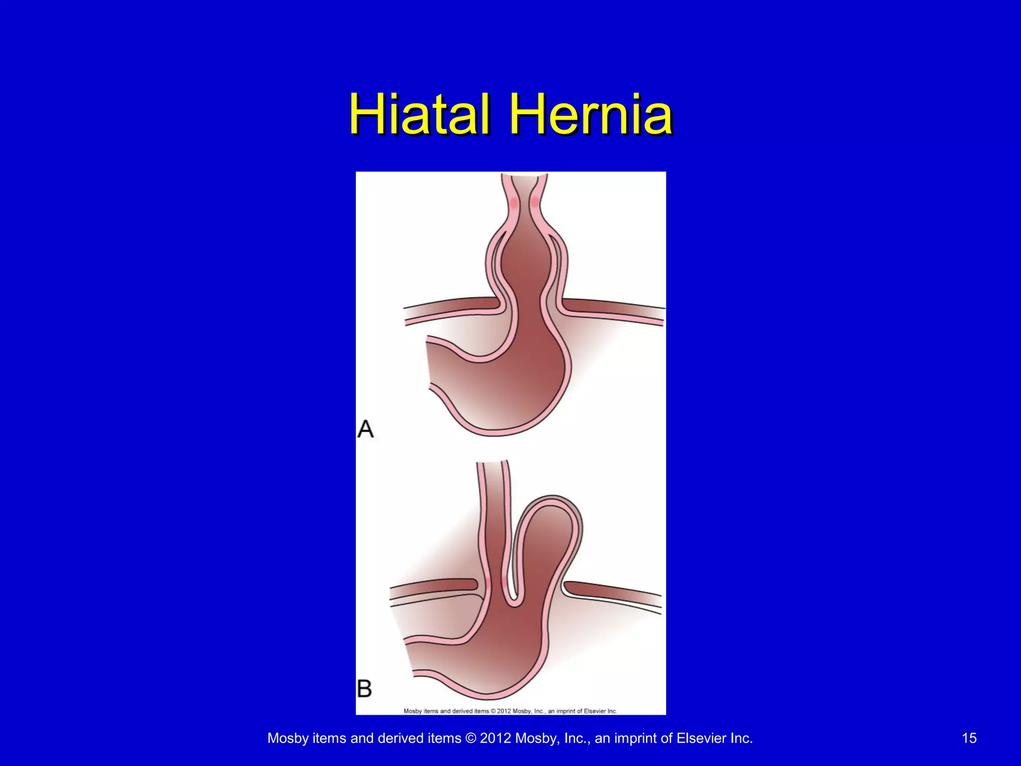 Mosby items and derived items © 2012 Mosby, Inc., an imprint of Elsevier Inc. 15
Hiatal HerniaHiatal Hernia
 