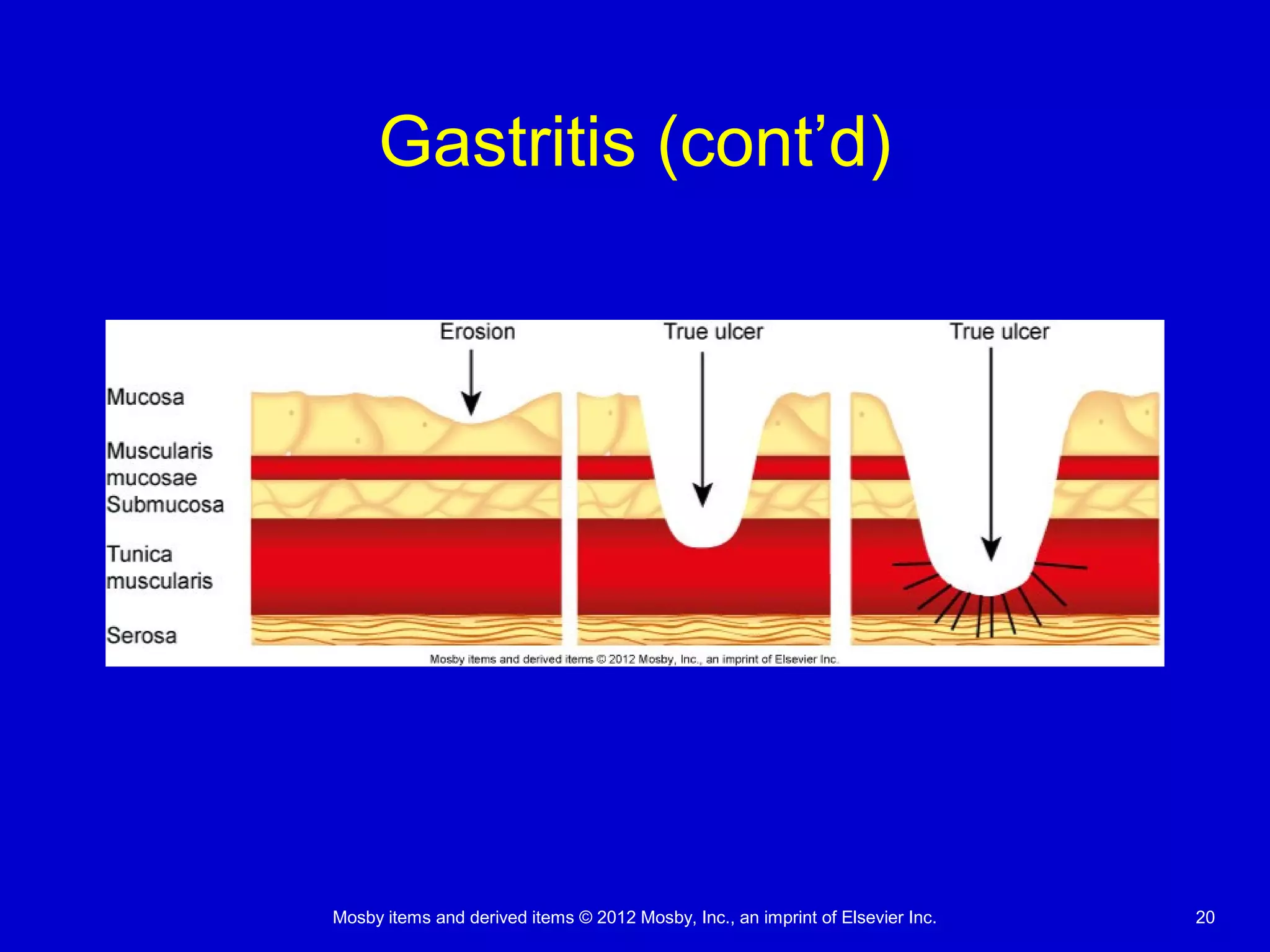 Mosby items and derived items © 2012 Mosby, Inc., an imprint of Elsevier Inc. 20
Gastritis (cont’d)
 