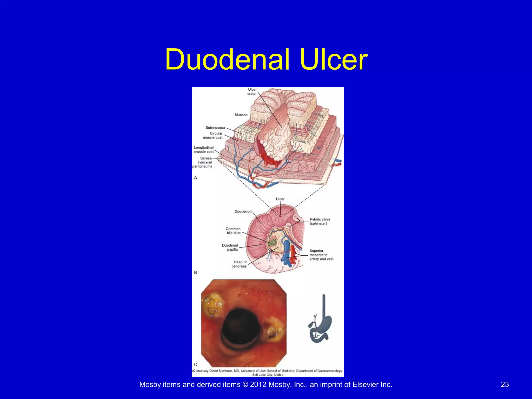 Mosby items and derived items © 2012 Mosby, Inc., an imprint of Elsevier Inc. 23
Duodenal Ulcer
 