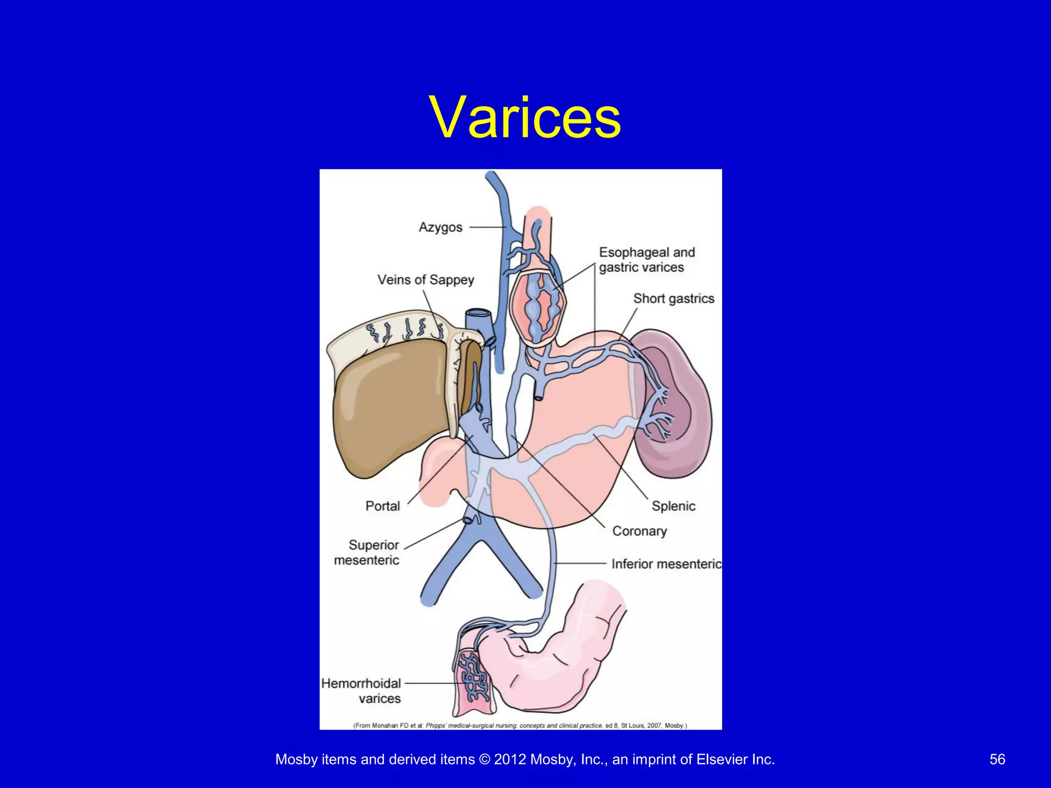 Mosby items and derived items © 2012 Mosby, Inc., an imprint of Elsevier Inc. 56
Varices
 