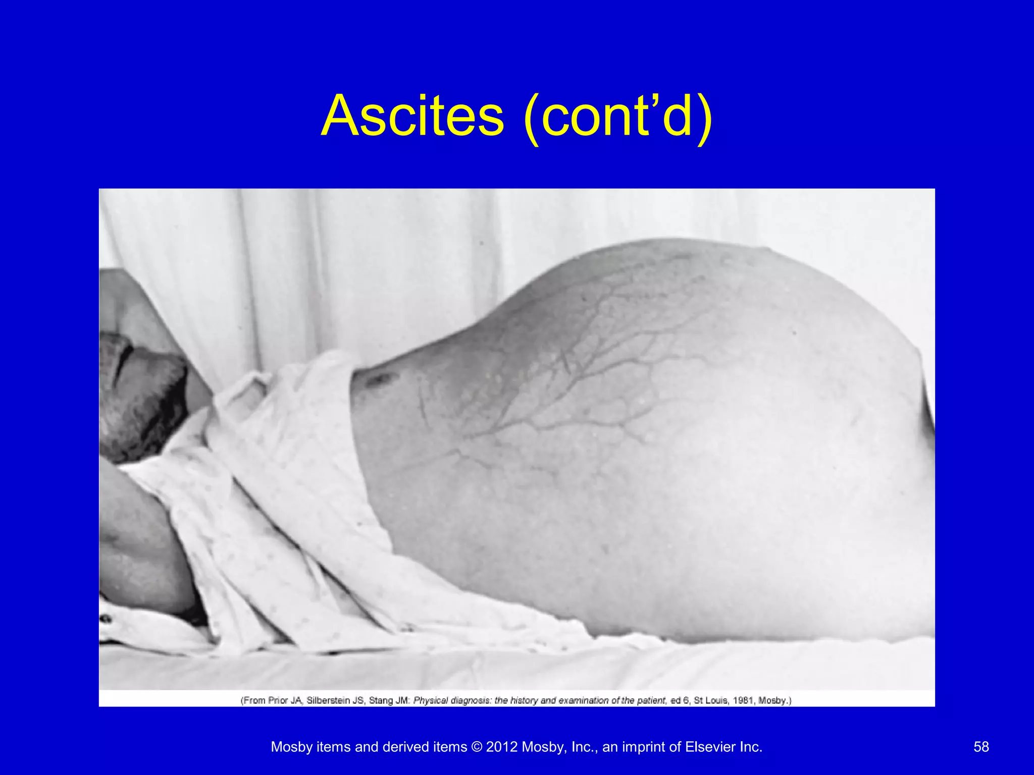 Mosby items and derived items © 2012 Mosby, Inc., an imprint of Elsevier Inc. 58
Ascites (cont’d)
 