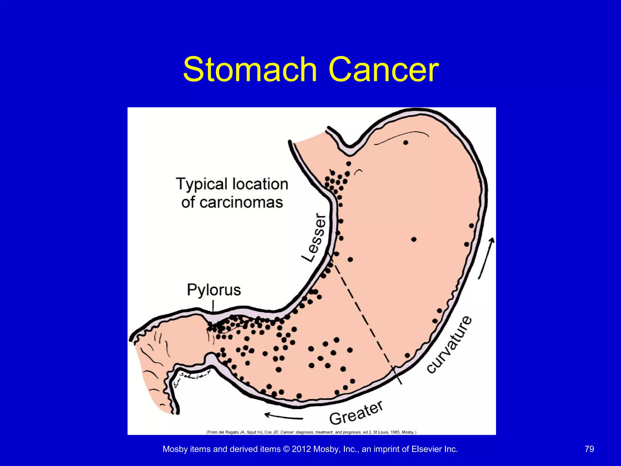 Mosby items and derived items © 2012 Mosby, Inc., an imprint of Elsevier Inc. 79
Stomach Cancer
 