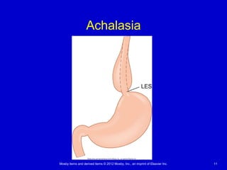 Mosby items and derived items © 2012 Mosby, Inc., an imprint of Elsevier Inc. 11
Achalasia
 