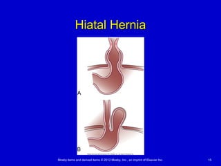 Mosby items and derived items © 2012 Mosby, Inc., an imprint of Elsevier Inc. 15
Hiatal HerniaHiatal Hernia
 