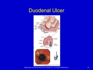 Mosby items and derived items © 2012 Mosby, Inc., an imprint of Elsevier Inc. 23
Duodenal Ulcer
 
