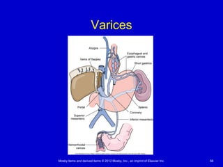 Mosby items and derived items © 2012 Mosby, Inc., an imprint of Elsevier Inc. 56
Varices
 