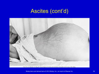 Mosby items and derived items © 2012 Mosby, Inc., an imprint of Elsevier Inc. 58
Ascites (cont’d)
 