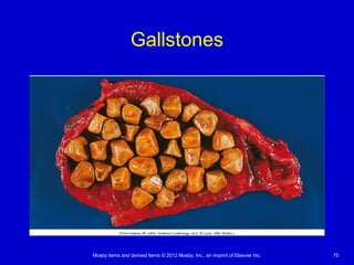 Mosby items and derived items © 2012 Mosby, Inc., an imprint of Elsevier Inc. 75
Gallstones
 