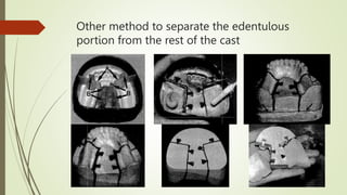 Other method to separate the edentulous
portion from the rest of the cast
 