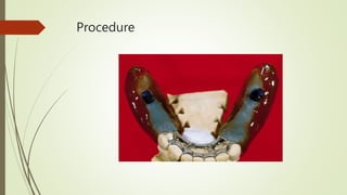 Procedure
 