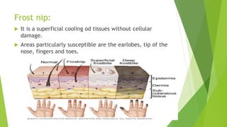 Frost nip:
 It is a superficial cooling od tissues without cellular
damage.
 Areas particularly susceptible are the earlobes, tip of the
nose, fingers and toes.
 