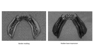 Altered Cast Technique for Distal Extension Removable Partial Dentures ...