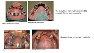 Altered Cast Technique for Distal Extension Removable Partial Dentures ...