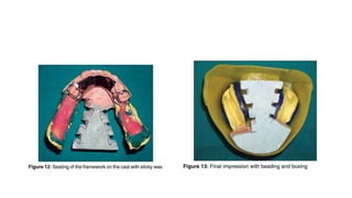 Altered Cast Technique for Distal Extension Removable Partial Dentures ...