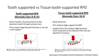 Altered Cast Technique for Distal Extension Removable Partial Dentures ...
