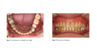 Altered Cast Technique for Distal Extension Removable Partial Dentures ...