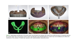Altered Cast Technique for Distal Extension Removable Partial Dentures ...
