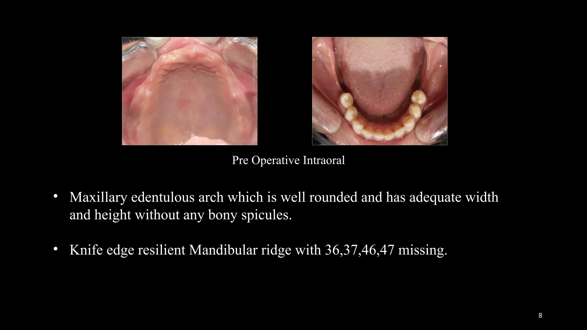 Altered Cast Technique removable partial denture 3.1.pptx